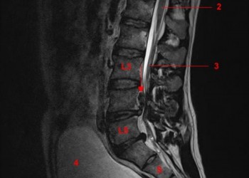 Le syndrome de la queue de cheval : un cas d'urgence