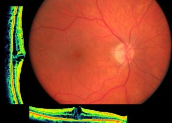 Oedème maculaire : une affection qui touche la rétine