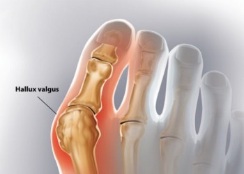 Hallux valgus - Oignon
